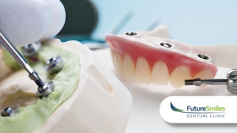 The Benefits of Implant-Supported Dentures: Why They Might Be Your Best Option 